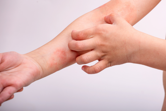 水道水の塩素とアトピー肌の関連性は?シャワーヘッドでできる対策をしよう