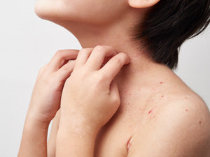 いつのまにかできる湿疹を予防する方法と対処法について？